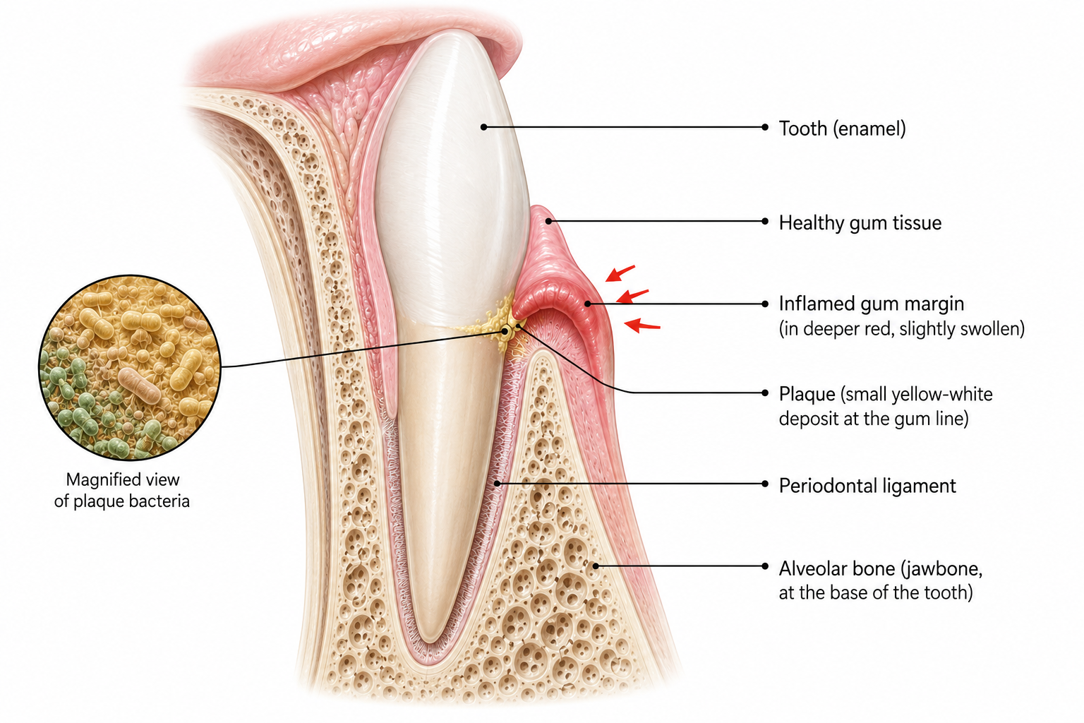 Gingivitis